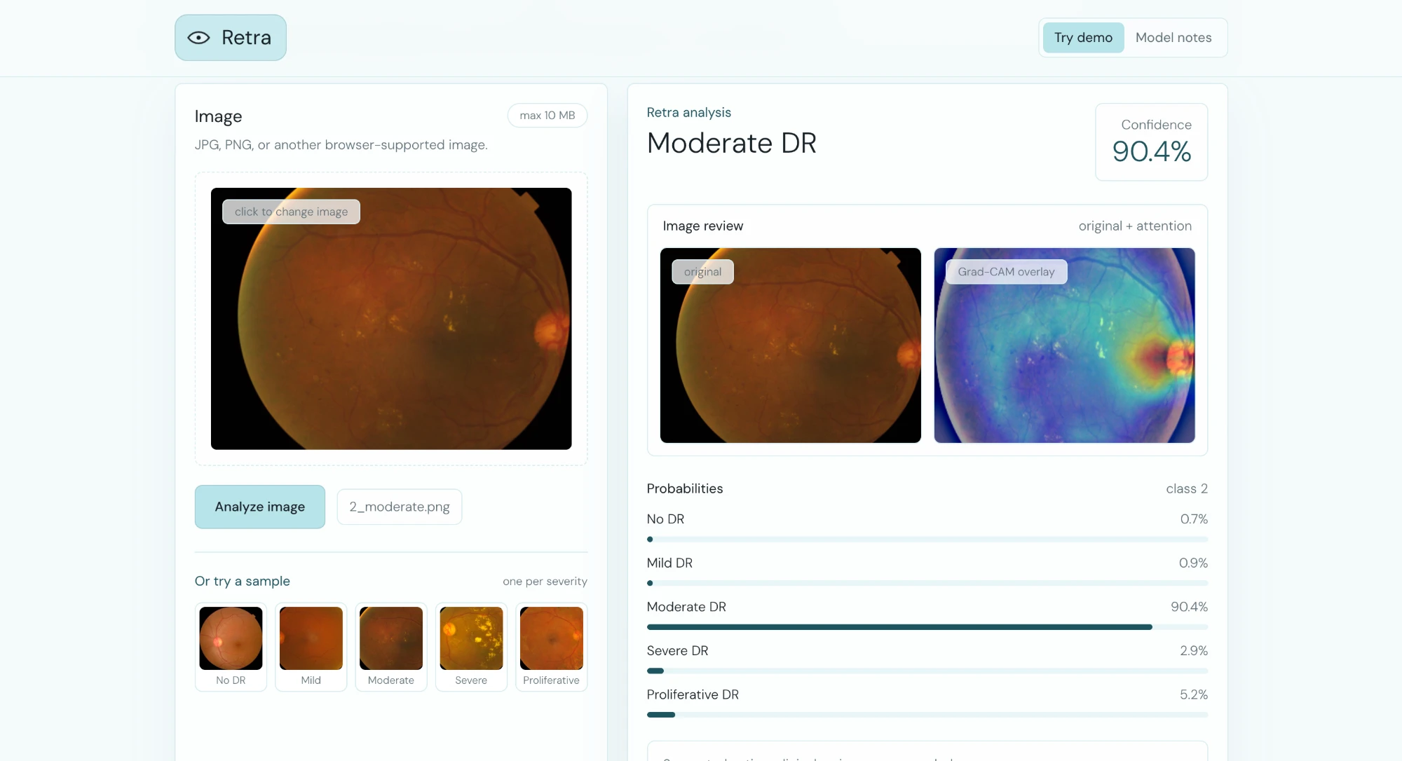 Retra grading a fundus image as moderate DR beside its Grad-CAM overlay and class probabilities